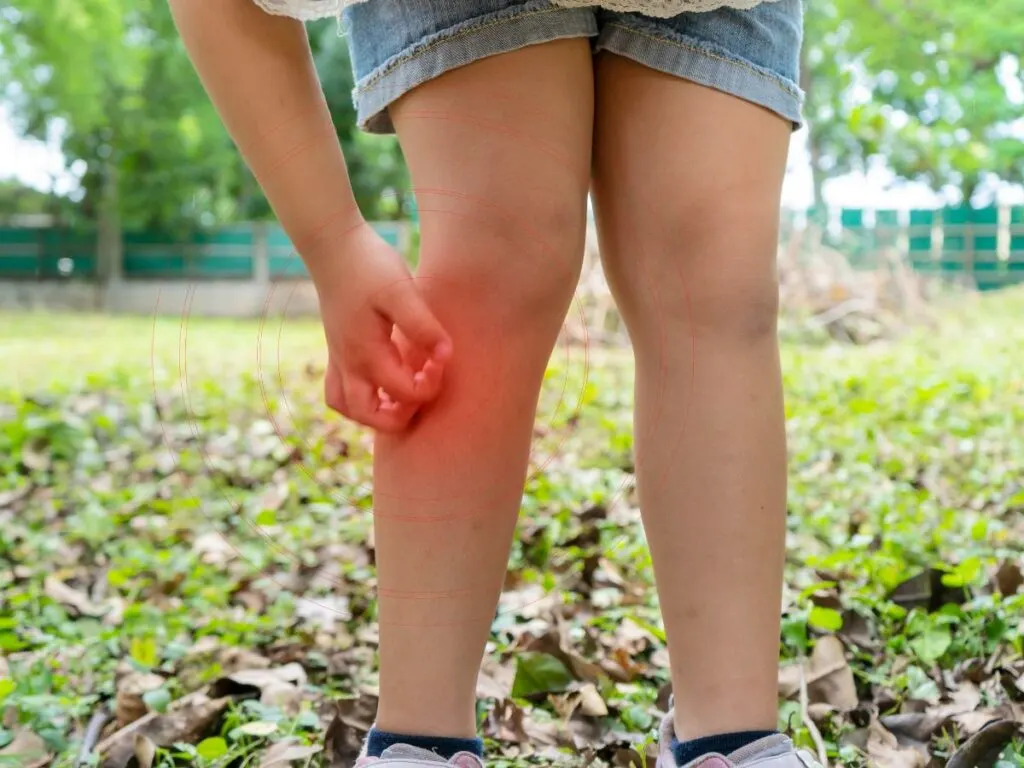 A child with mosquito bite on leg.